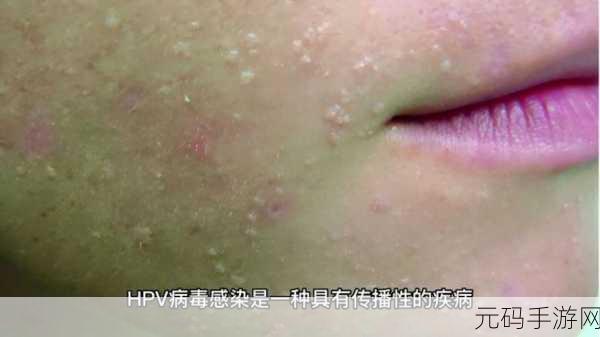HPV感染与性接触关系解析,1. HPV感染:性接触背后的隐秘真相